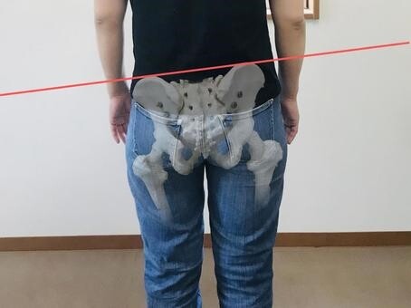 骨盤歪み